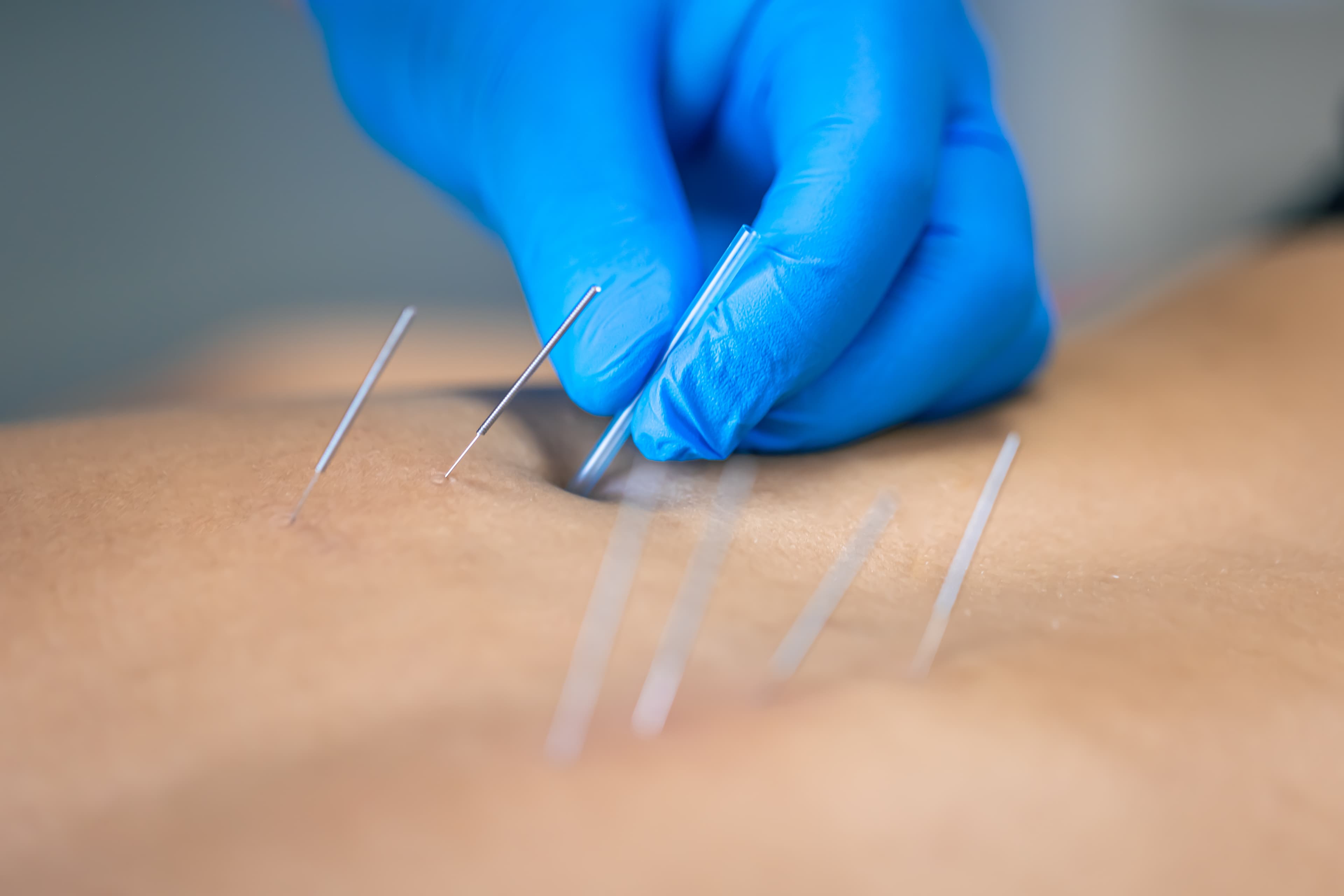 Dry Needling терапија: прецизно ослободување на тригер точки